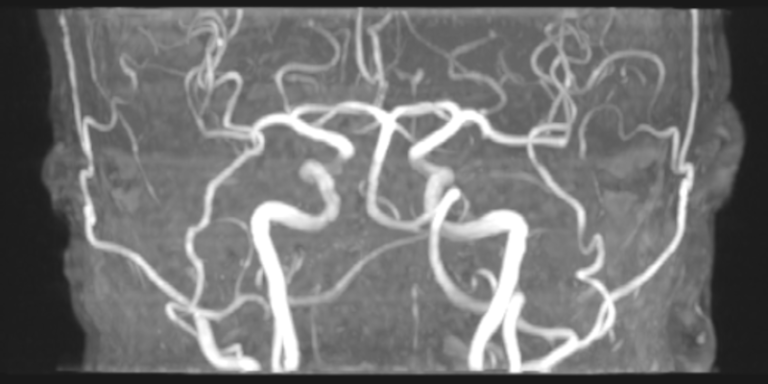 MRT Angio intracranielle Gefäße